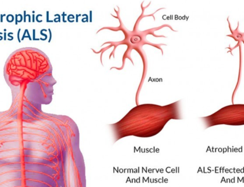 ALS – Skleroza Laterale Amyotrofike