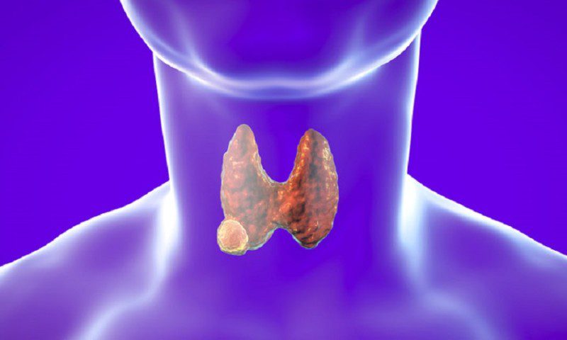 thyroid-nodules-arabic-herbal-medicine