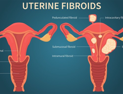 Udhëzues për Fibroidet Uterine