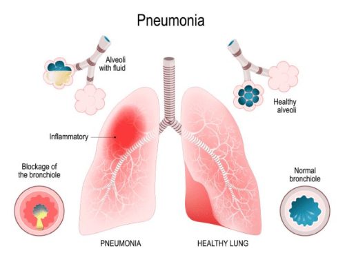 Zbulohet shkaku kryesor i rrezikut të Pneumonisë