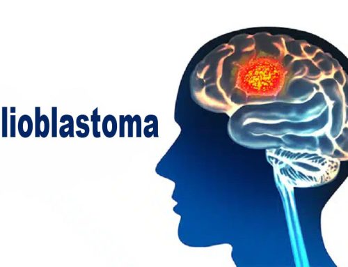 Çfarë është Glioblastoma dhe cila është shkalla e mbijetesës?