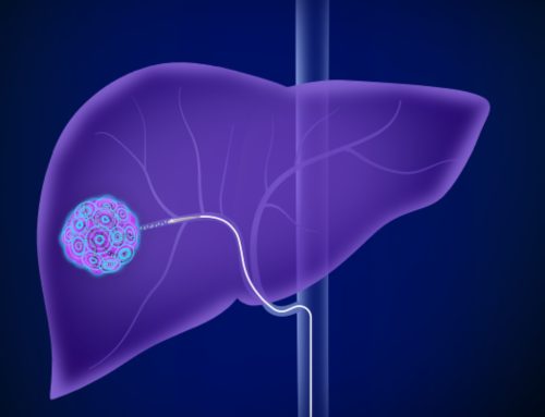 Rastet e kancerit të mëlçisë pritet të dyfishohen deri në vitin 2050